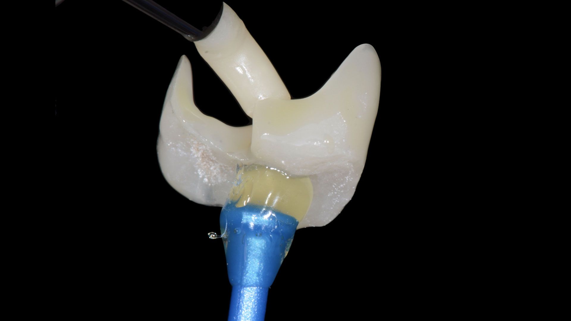 materiali per intarsi dentali